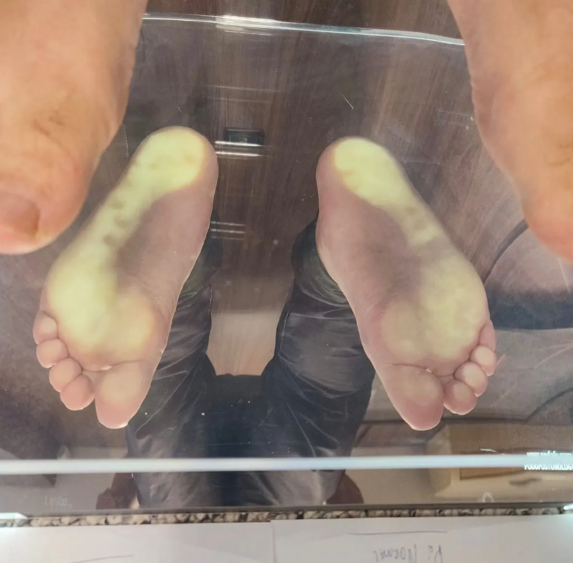 Análise de pisada computadorizada